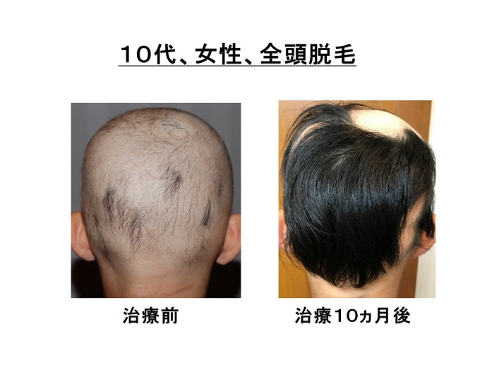 汎発性脱毛　名医
